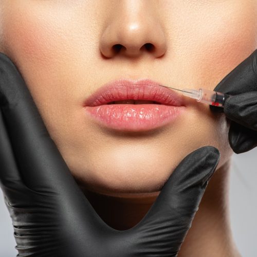 Young Woman Getting Lip Filler | True Beauty Forever in in Kaysville, UT